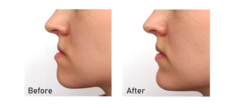 before-and-after-corrective-jaw-surgery