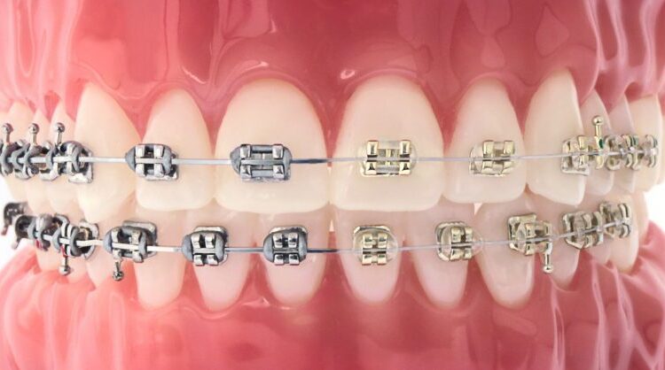 Traditional Metal And Esthetic Gold Braces