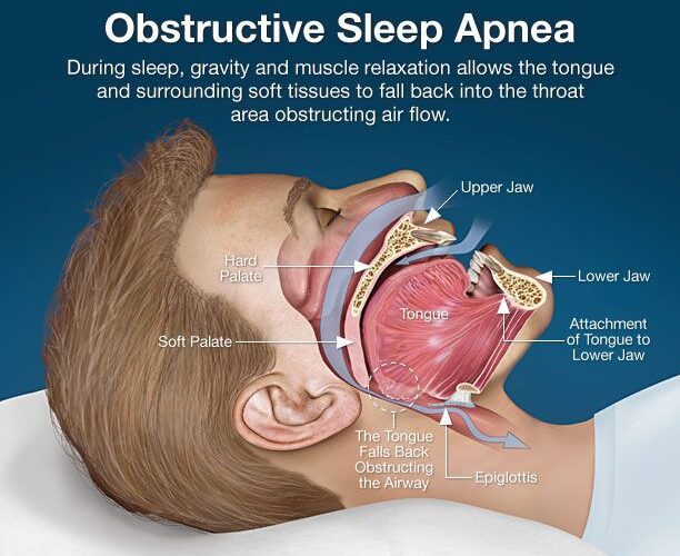 Sleep Apnea and Airway Aware Treatment