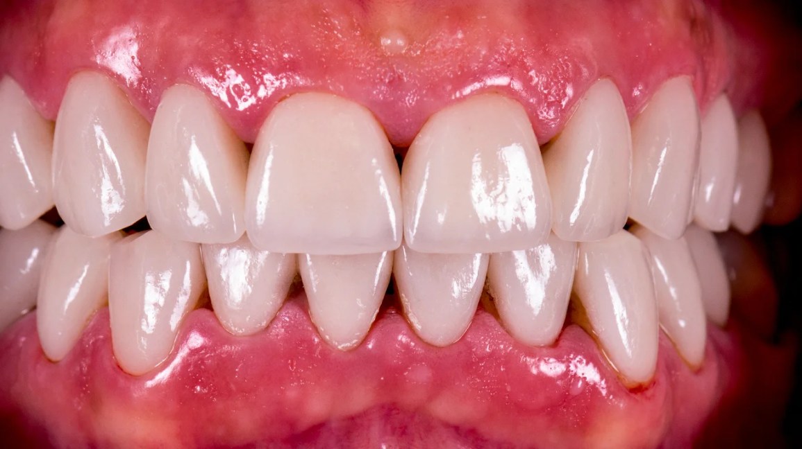 Closing Gaps Between Teeth - What are Black Triangles
