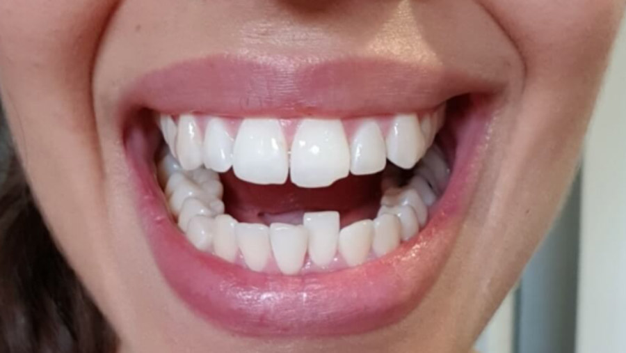 Can You Straighten Just One Crooked Tooth