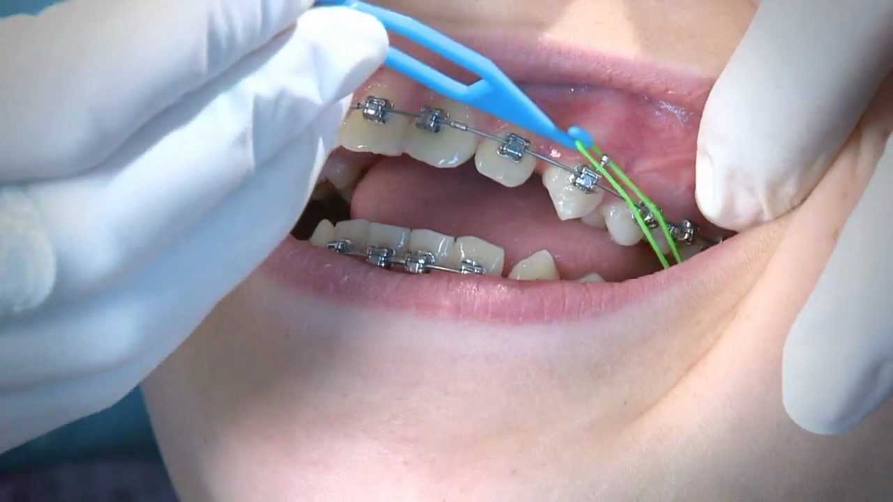 Orthodontic Rubber Bands