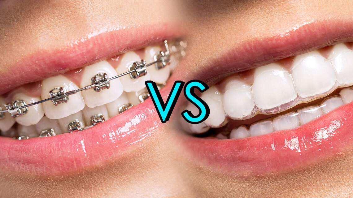 Braces vs Invisalign