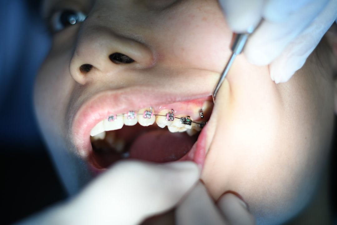 Understanding Bolton Discrepancies in Orthodontics - Joe Orthodontics in Victorville