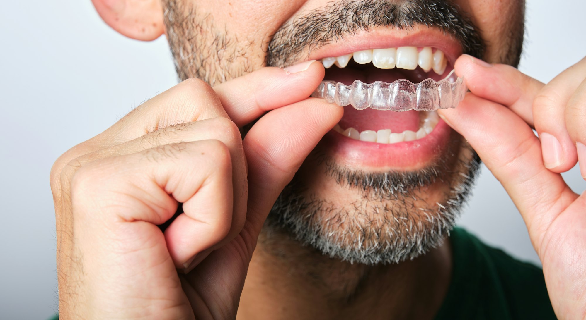 retainers